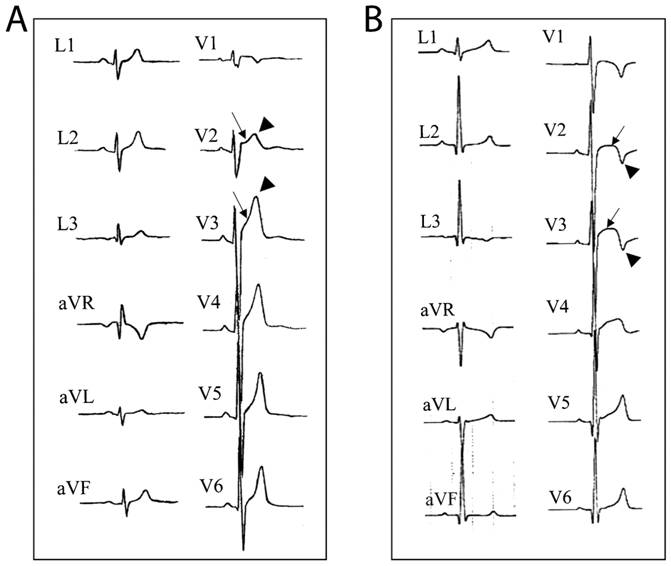 EKG_InsideTracker